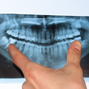 X-ray-of-wisdom-teeth