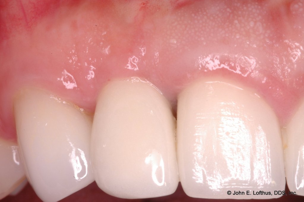 Dental Implant After Image