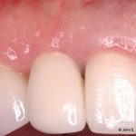 Dental Implant After Image
