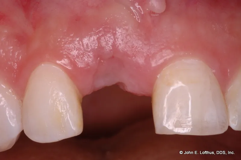 Dental Implant Before Image