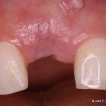 Dental Implant Before Image