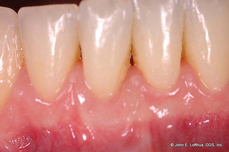Periodontal Plastic Surgery After Image