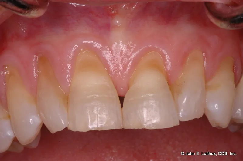 Periodontal Plastic Surgery Before Image