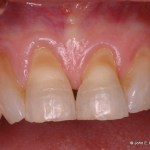 Periodontal Plastic Surgery Before Image