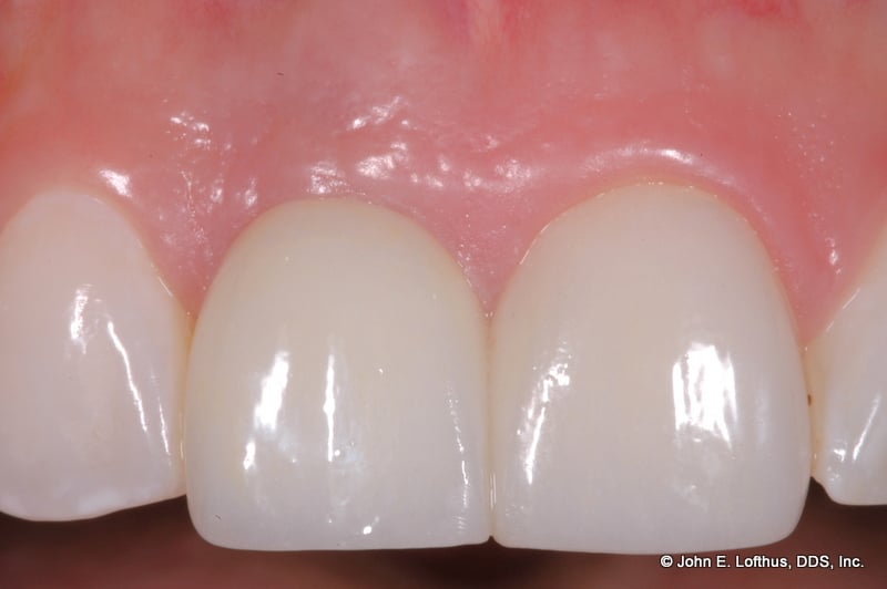 Dental Implant After Image