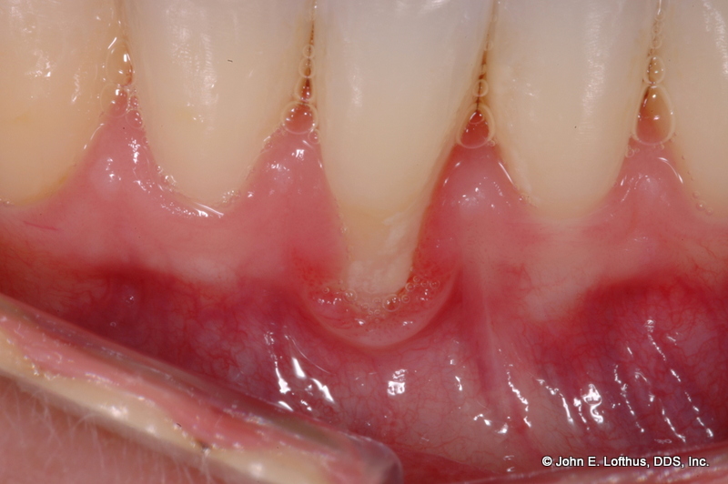 Periodontal Plastic Surgery Before Image