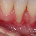 Periodontal Plastic Surgery Before Image