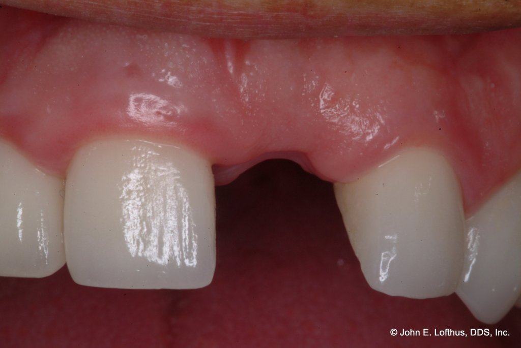 Dental Implant Before Image