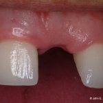 Dental Implant Before Image