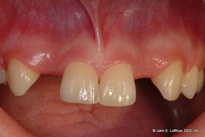 Dental Implant Before Image