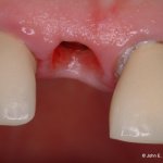 Dental Implant Before Image