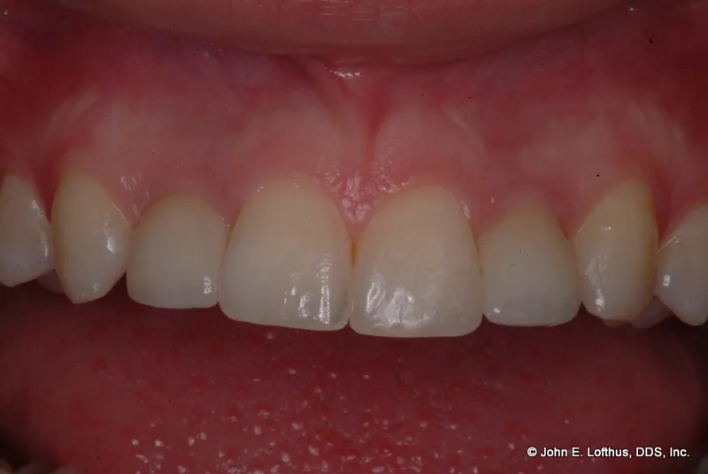 Dental Implant After Image