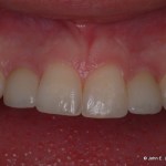 Dental Implant After Image