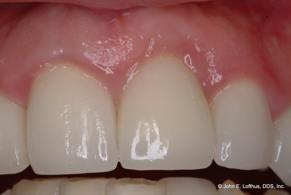 Dental Implant After Image
