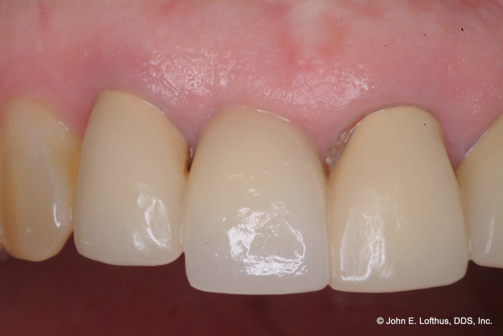 Dental Implant After Image