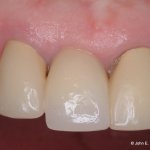 Dental Implant After Image