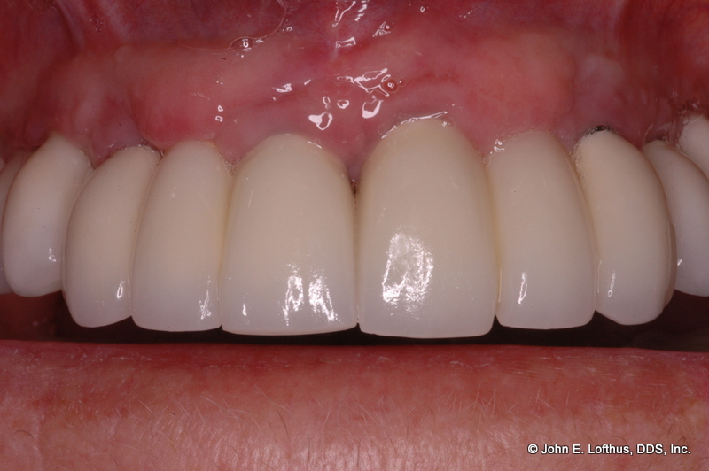 Dental Implant After Image