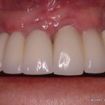 Dental Implant After Image