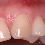 Periodontal Plastic Surgery After Image