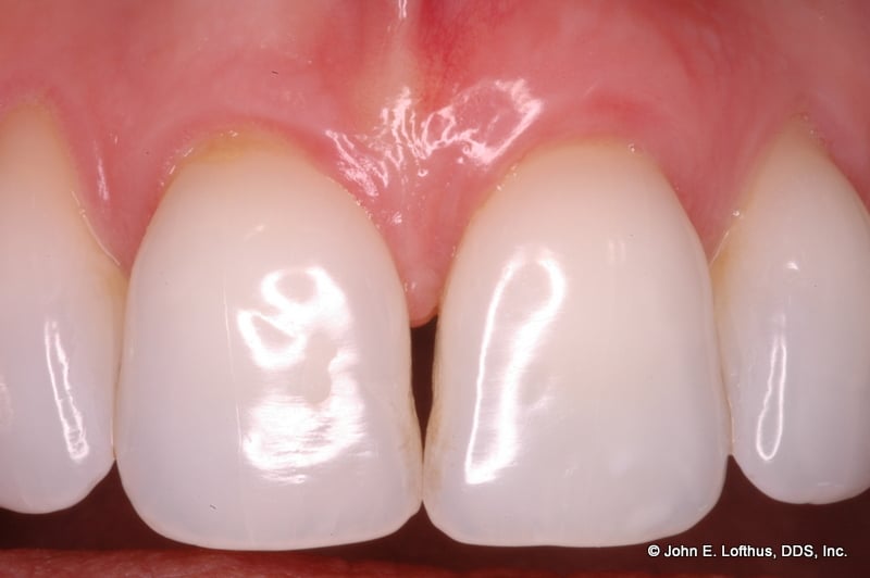 Periodontal Plastic Surgery After Image