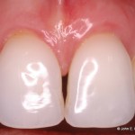 Periodontal Plastic Surgery After Image