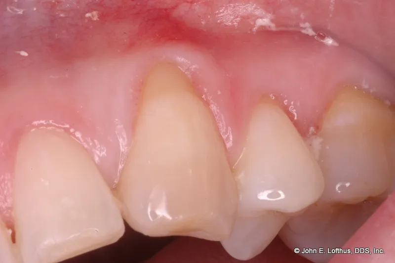 Periodontal Plastic Surgery Before Image