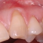Periodontal Plastic Surgery Before Image