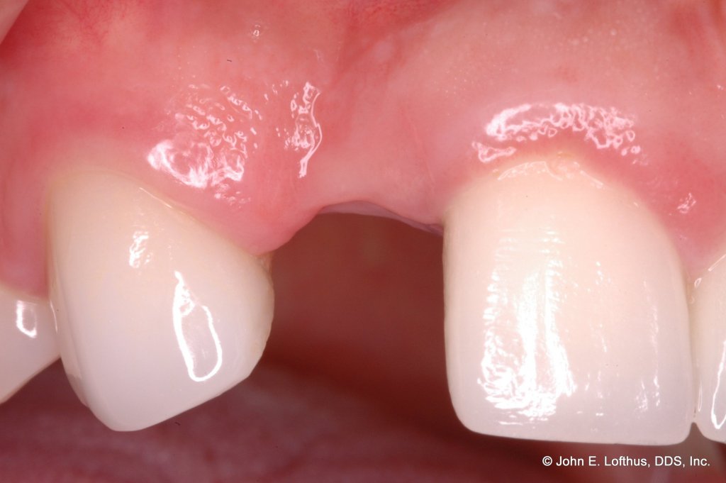 Dental Implant Before Image