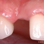 Dental Implant Before Image