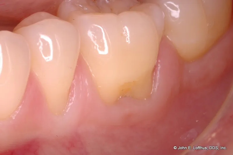 Periodontal Plastic Surgery Before Image