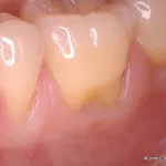 Periodontal Plastic Surgery Before Image