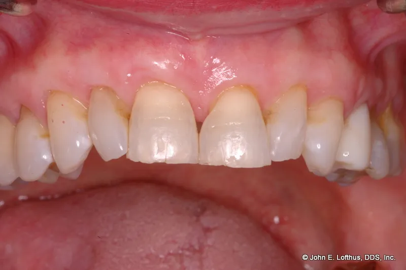 Periodontal Plastic Surgery After Image