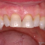 Periodontal Plastic Surgery After Image