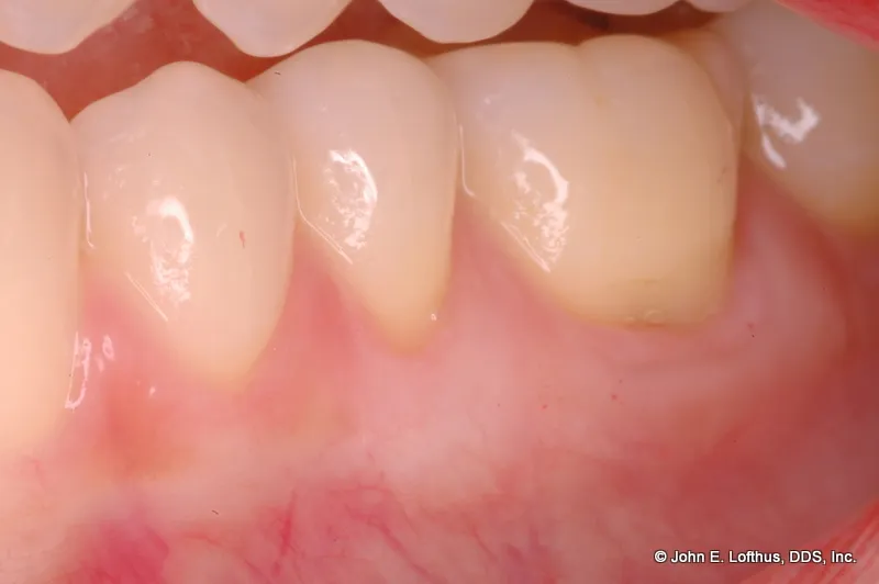 Periodontal Plastic Surgery After Image