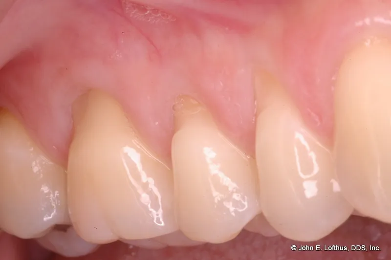 Periodontal Plastic Surgery Before Image