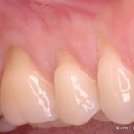 Periodontal Plastic Surgery Before Image