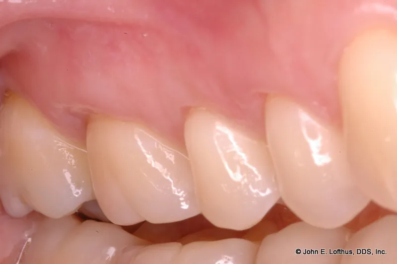 Periodontal Plastic Surgery After Image