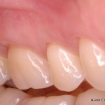 Periodontal Plastic Surgery After Image