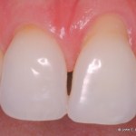 Periodontal Plastic Surgery Before Image