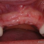 Dental Implant Before Image