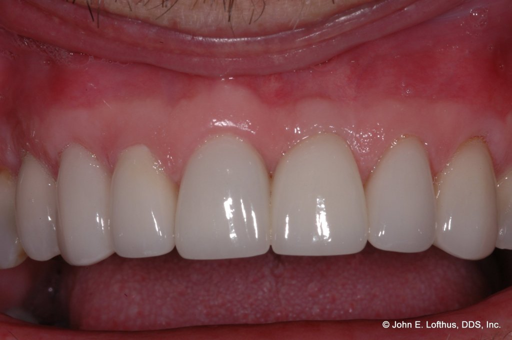 Periodontal Plastic Surgery After Image