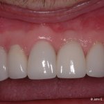 Periodontal Plastic Surgery After Image