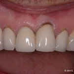 Periodontal Plastic Surgery Before Image