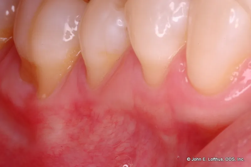 Periodontal Plastic Surgery Before Image