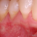 Periodontal Plastic Surgery Before Image
