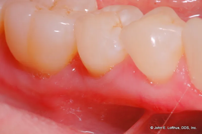 Periodontal Plastic Surgery After Image