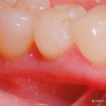 Periodontal Plastic Surgery After Image